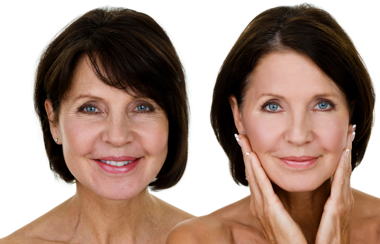 Older woman's face before and after botox