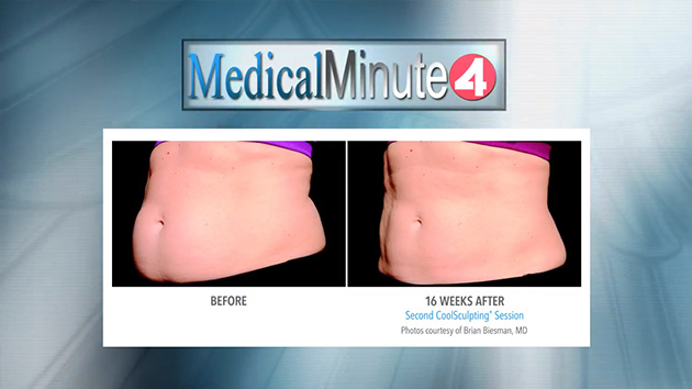 Client's before and after coolsculpting treatment