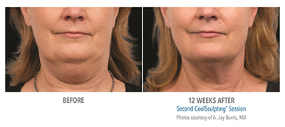 Before and after second session of coolsculpting