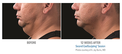Before and after coolsculpting treatment