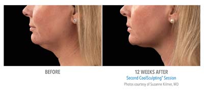 Before and after receiving Coolsculpting sessions