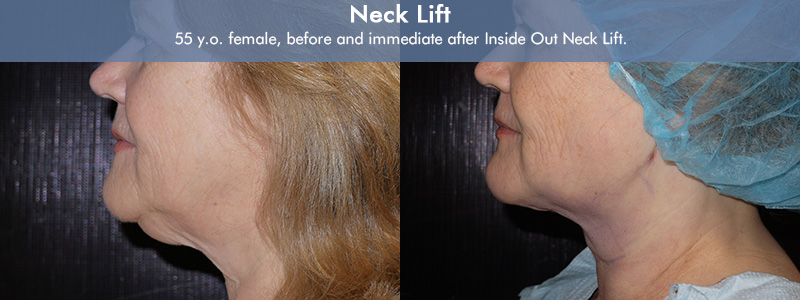 before and after inside out neck lift