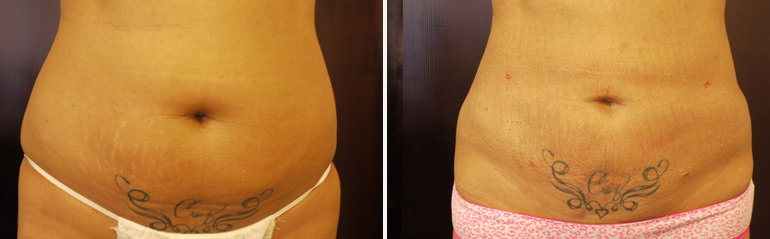 Liposuction | Dr. Sheena Kong
