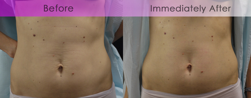 Dr. Sheena Kong photos of Tummy Tone-Up Before and After