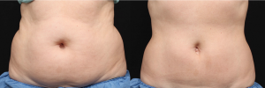 CoolSculpting before and after photos show excellent results on the abdomen.
