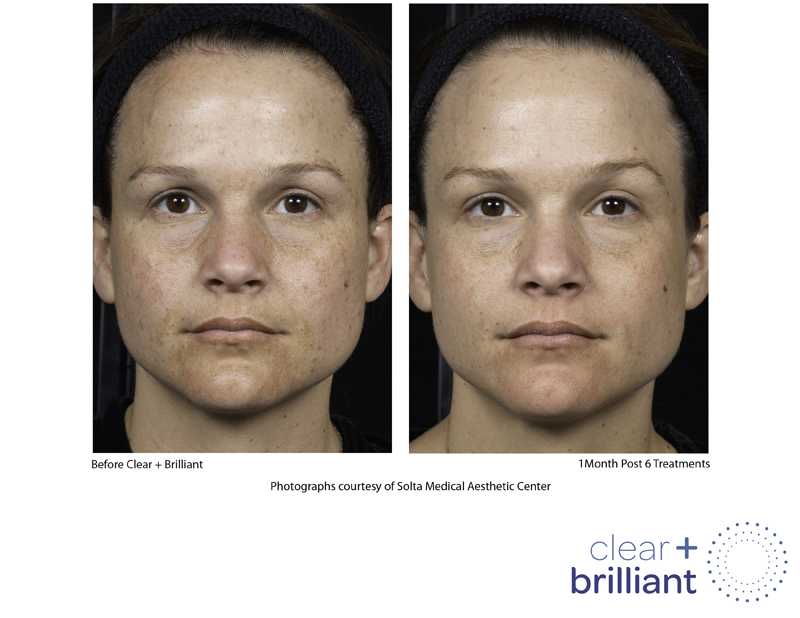 Clear Plus Brilliant Before & After 1