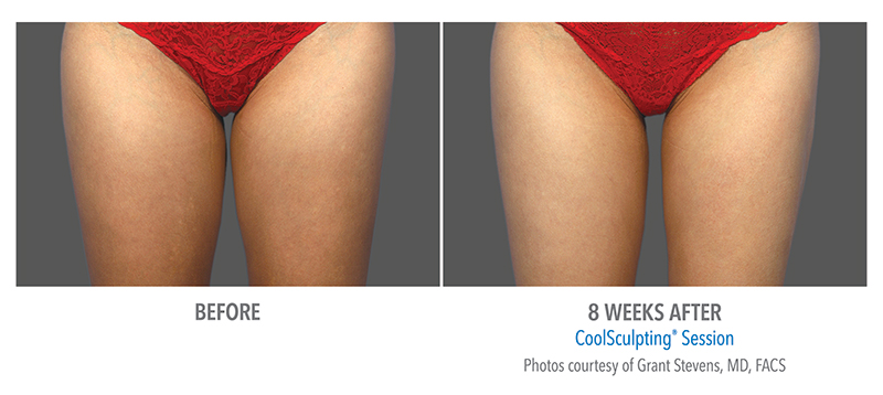 Coolsculpting Before & After 1