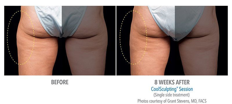Coolsculpting Before & After 2