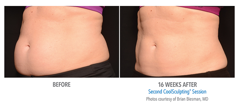 Coolsculpting Before & After 3
