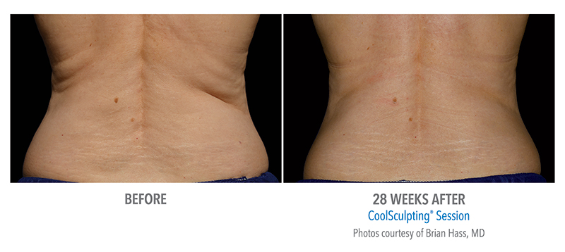 Coolsculpting Before & After 4