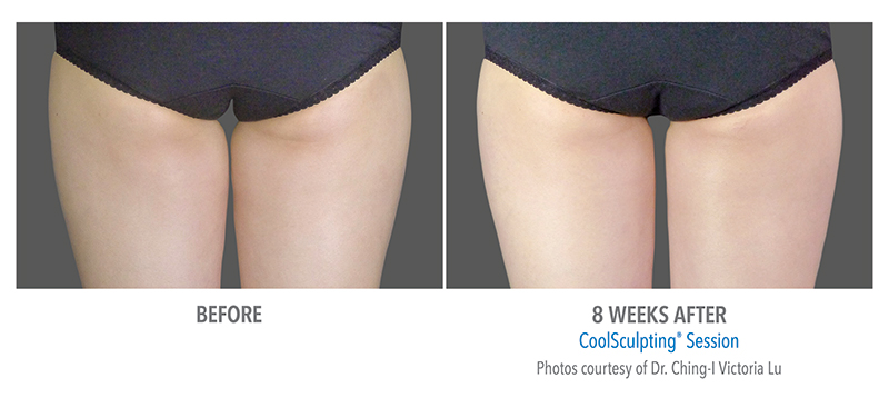 Coolsculpting Before & After 5