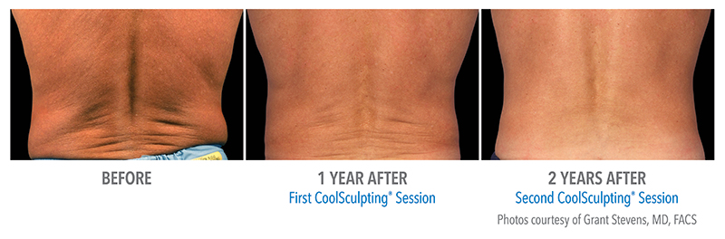 Coolsculpting Before & After 7