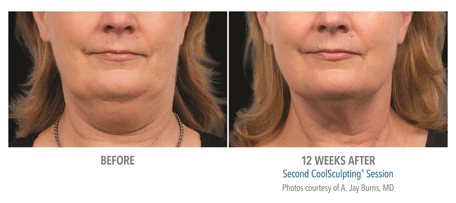 Coolsculpting Before & After 9