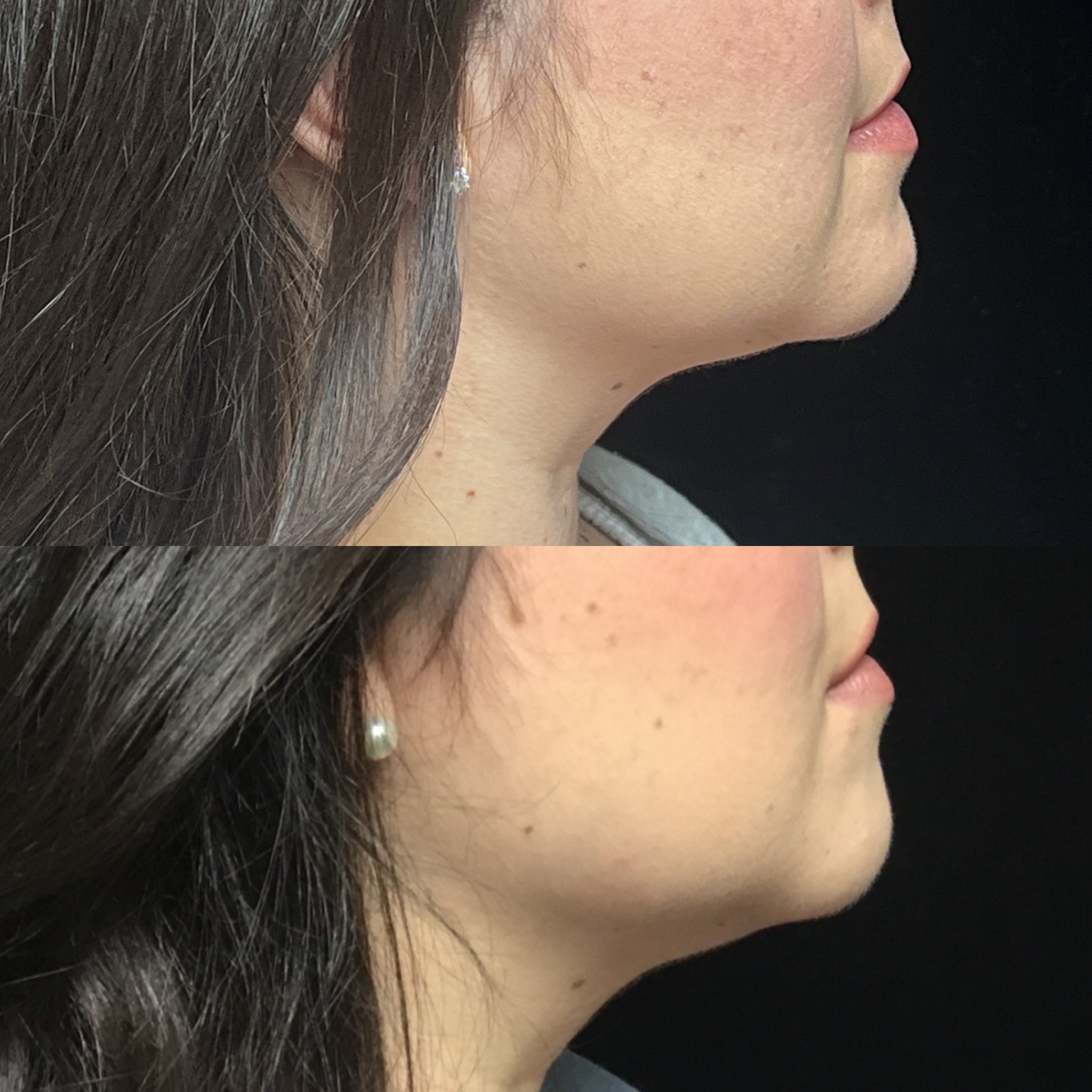 Coolsculpting Before & After 10