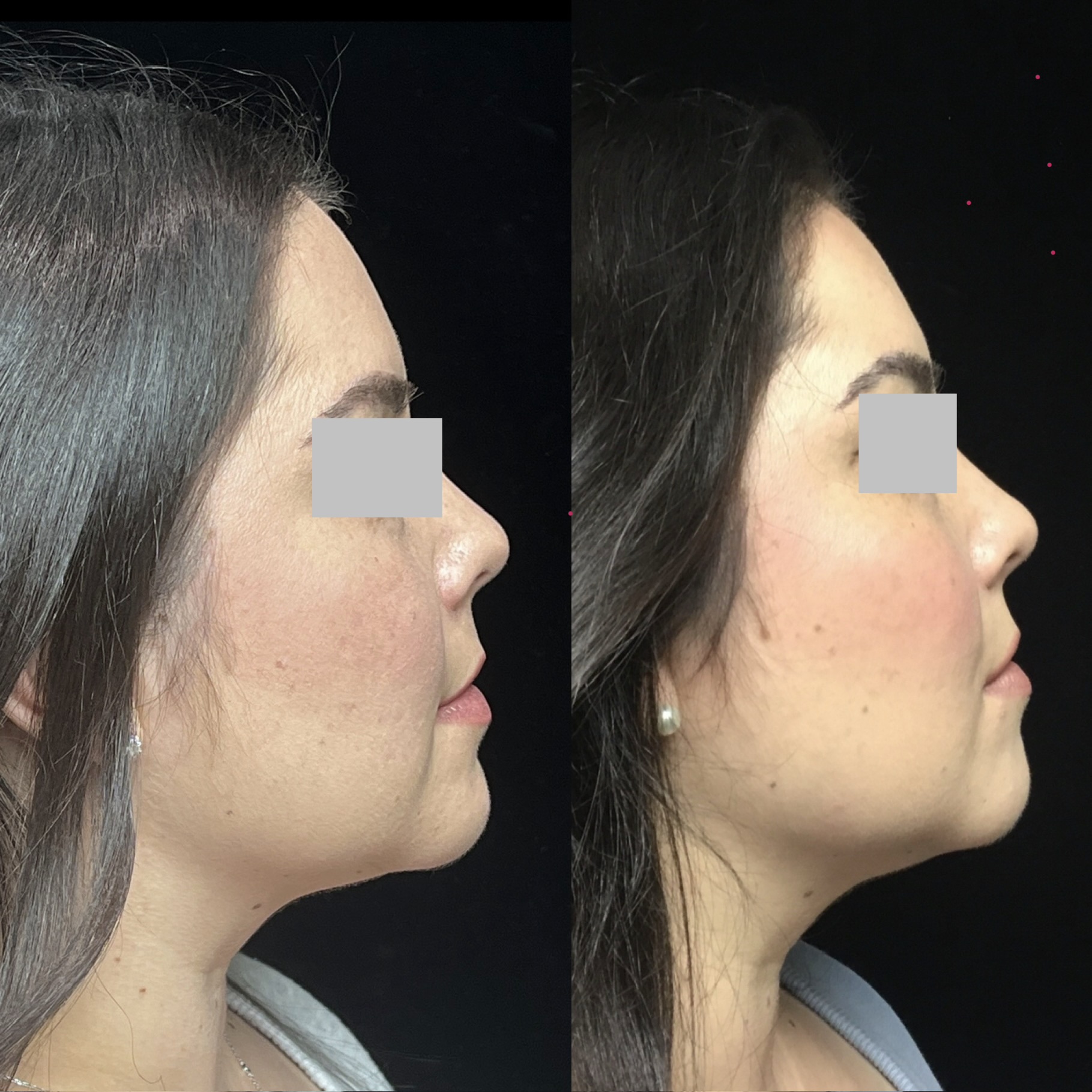 Coolsculpting Before & After 10