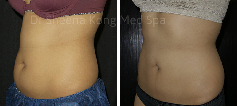Coolsculpting Before & After 11