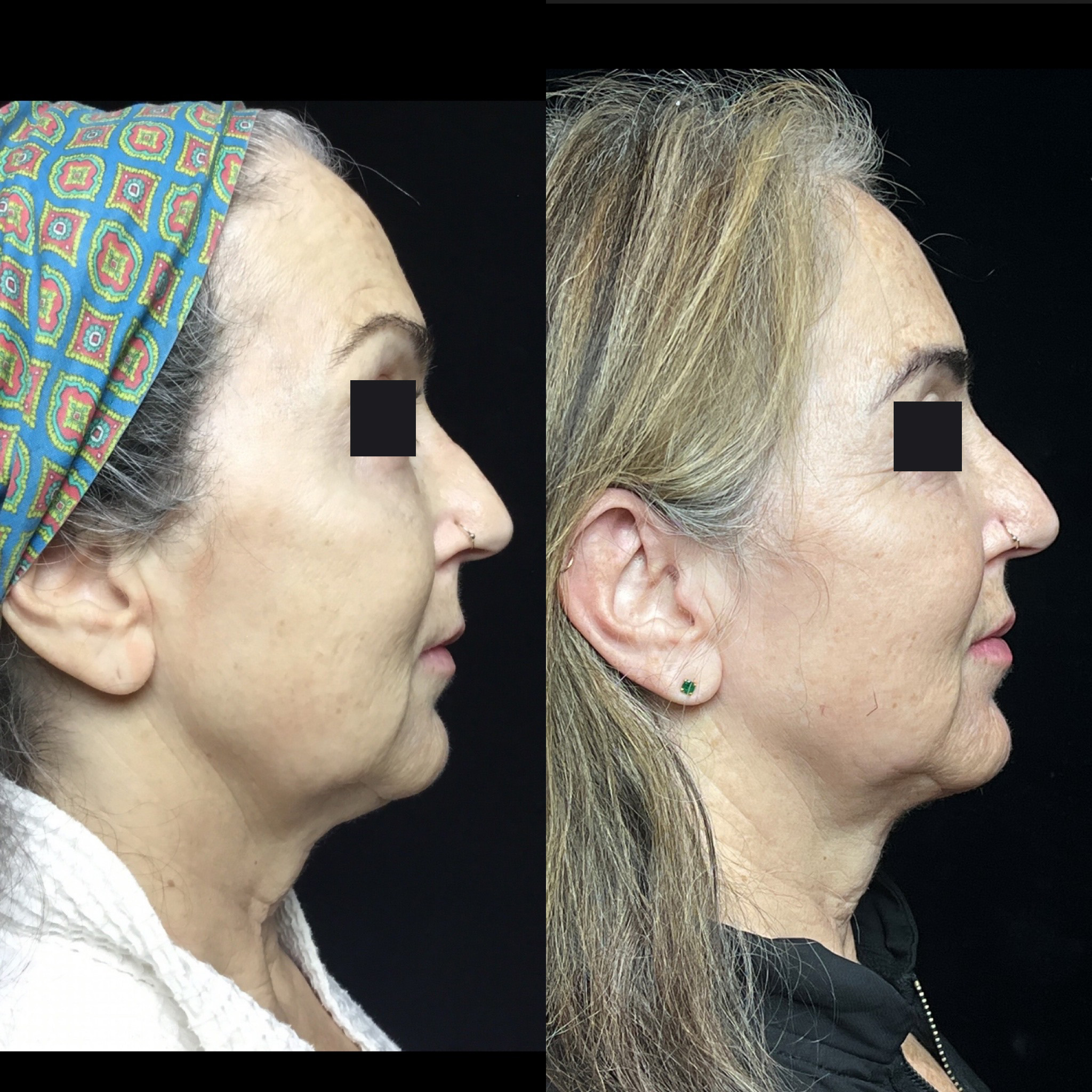 Coolsculpting Before & After 11