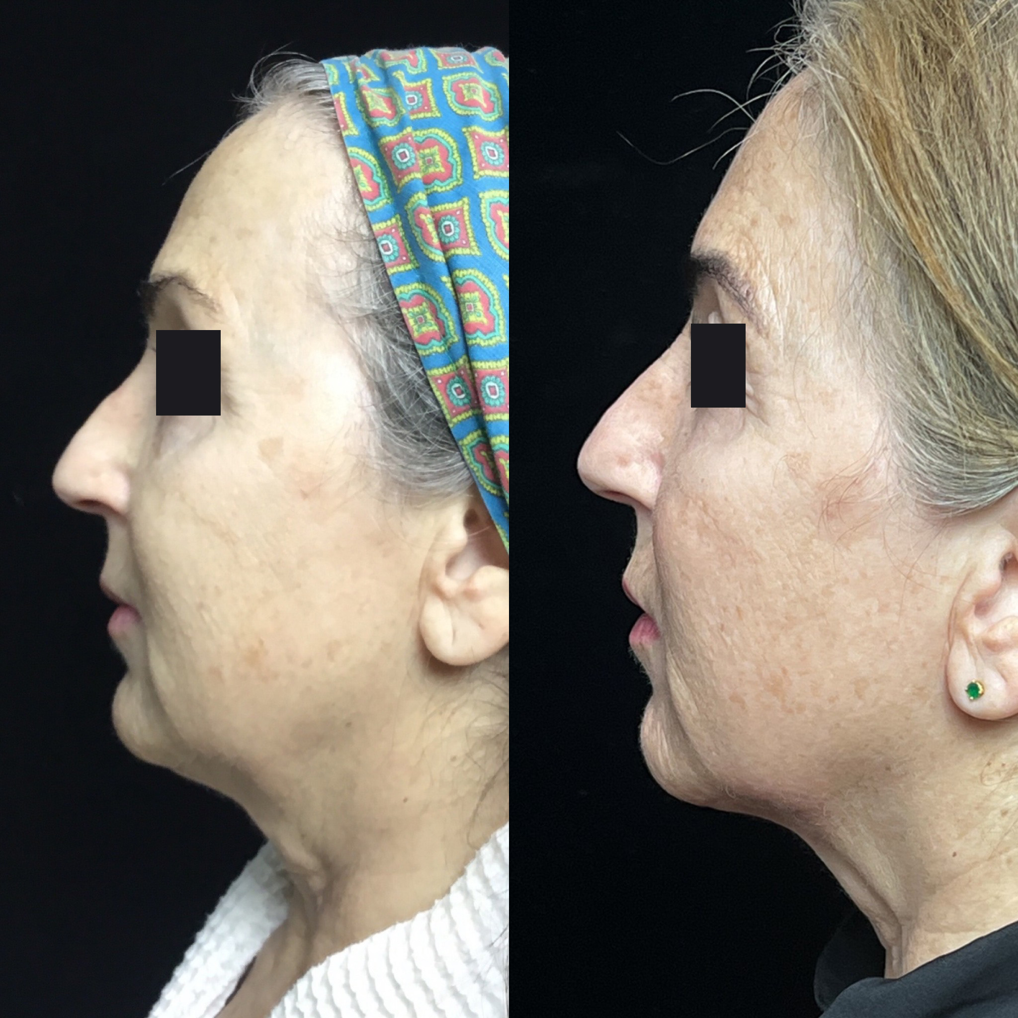 Coolsculpting Before & After 11
