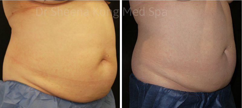 Coolsculpting Before & After 12