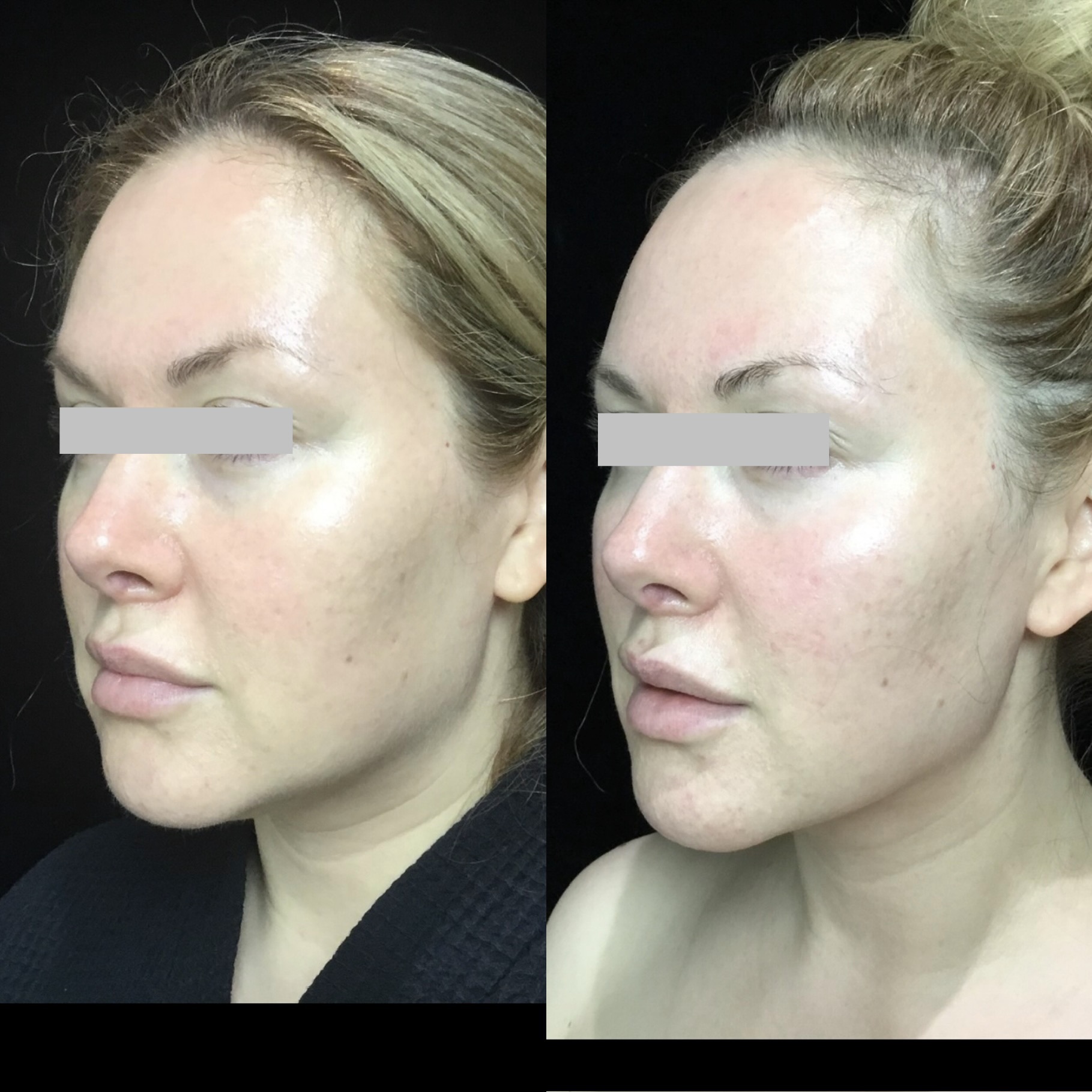 Coolsculpting Before & After 12