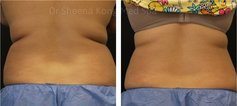 Coolsculpting Before & After 13