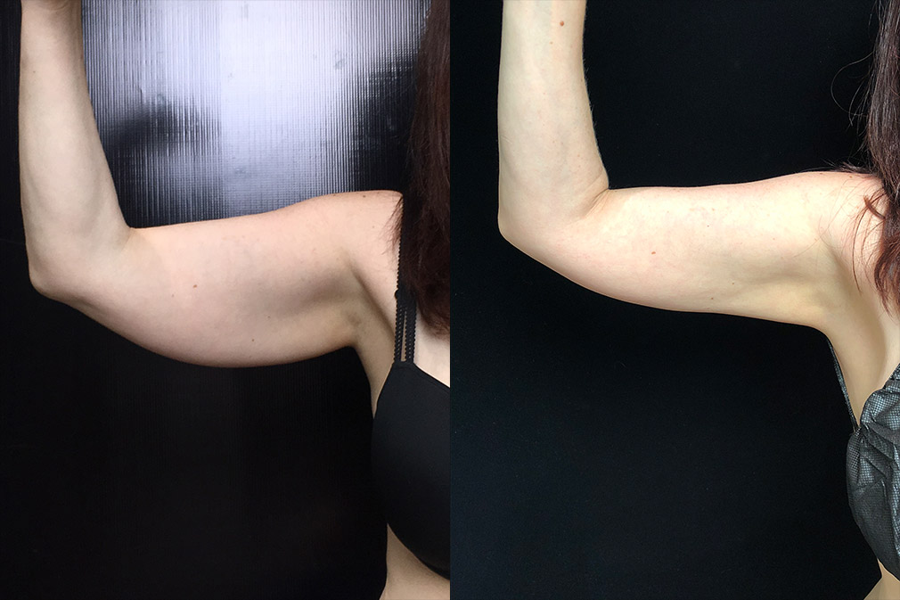 Coolsculpting Before & After 14