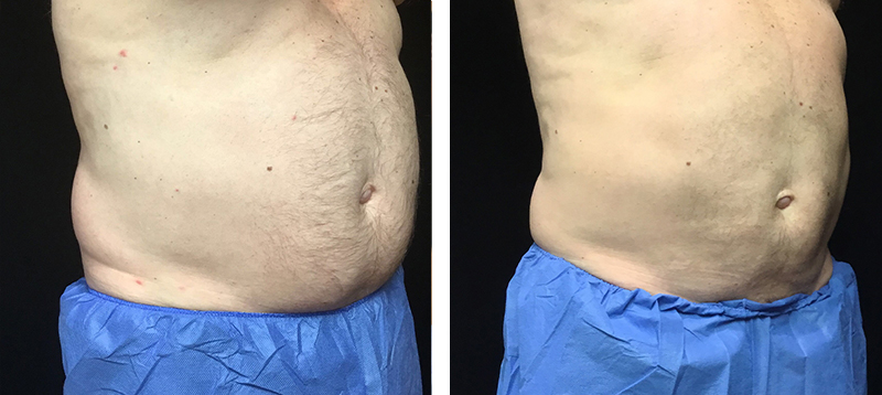 Coolsculpting Before & After 16