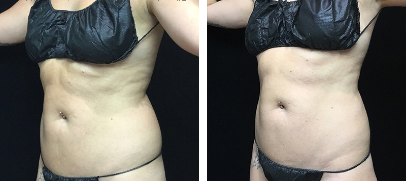 Coolsculpting Before & After 17