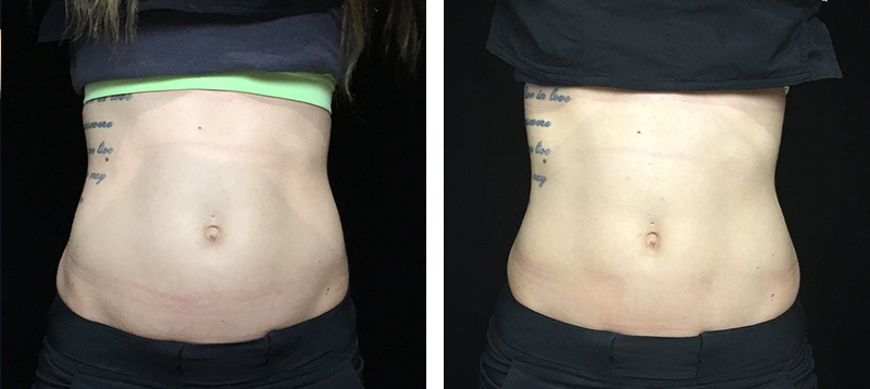 Coolsculpting Before & After 18
