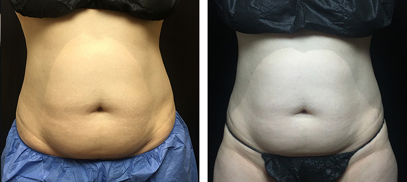 Coolsculpting Before & After 19