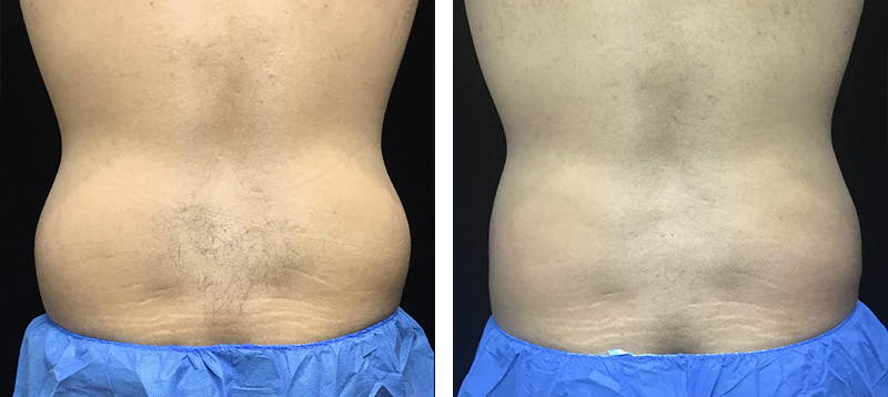 Coolsculpting Before & After 20