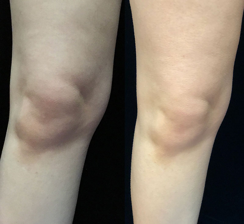 Coolsculpting Before & After 21