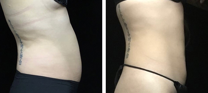 Coolsculpting Before & After 22