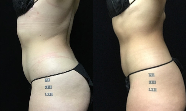 Coolsculpting Before & After 25
