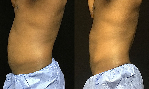 Coolsculpting Before & After 27