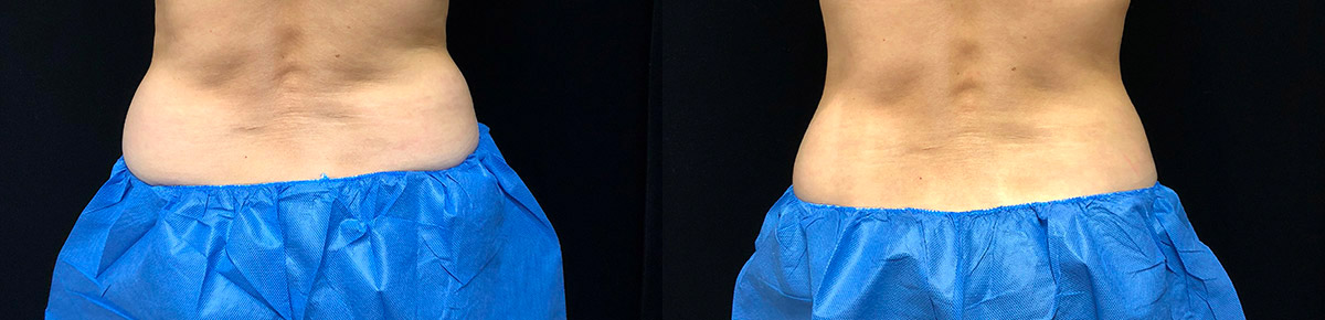 Coolsculpting Before & After 30