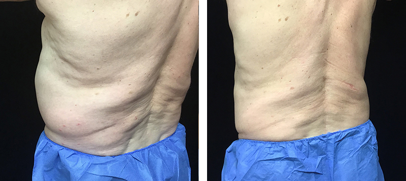 Coolsculpting Before & After 31