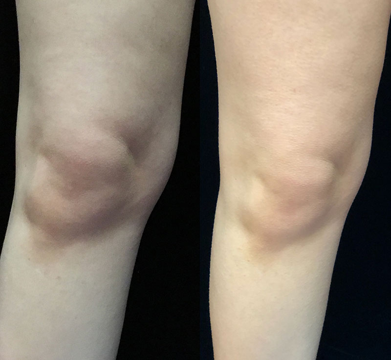 Coolsculpting Before & After 36