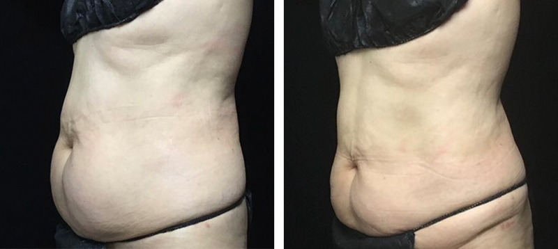 Coolsculpting Before & After 38