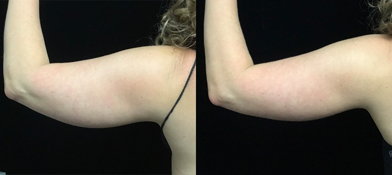 Coolsculpting Before & After 43