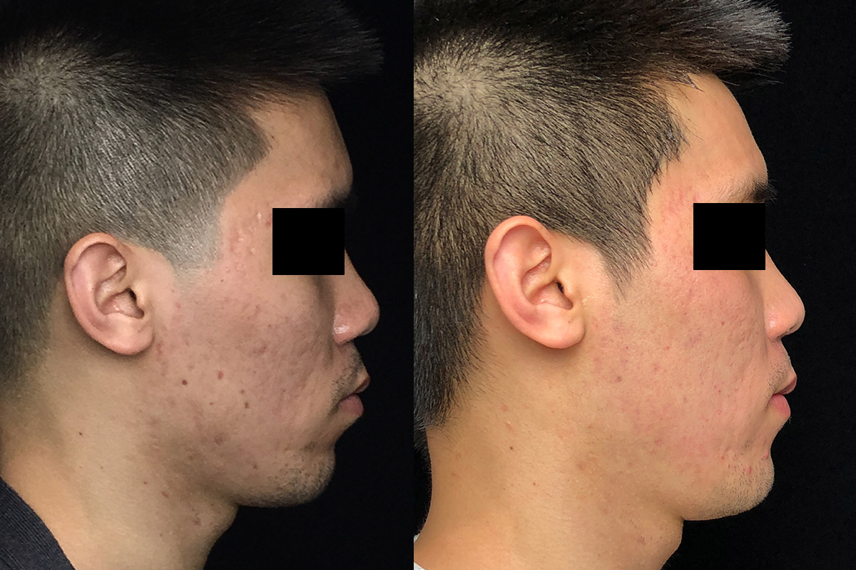 Fraxel Laser Before & After 8