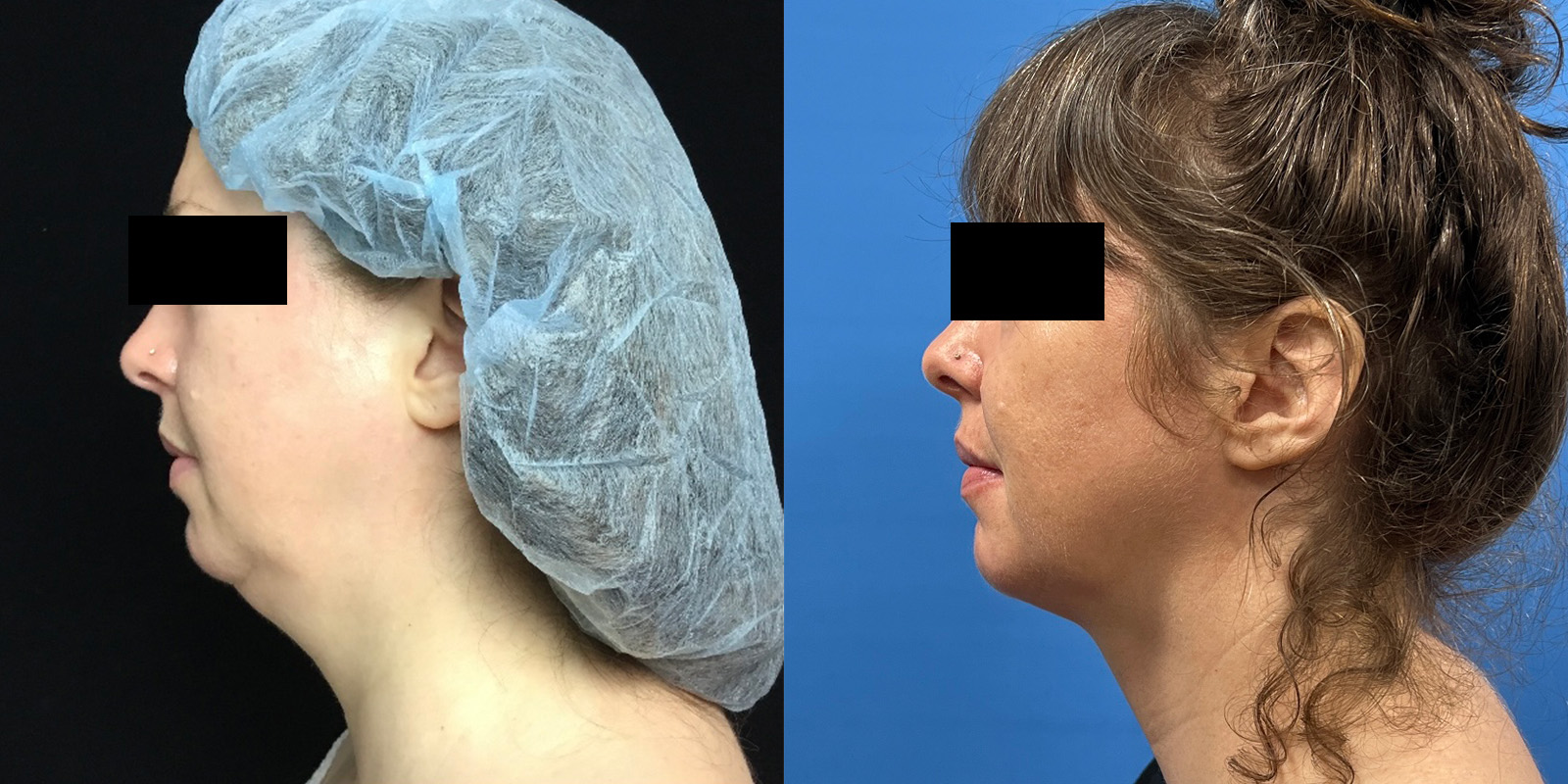 Inside Out Neck Lift Before & After 1