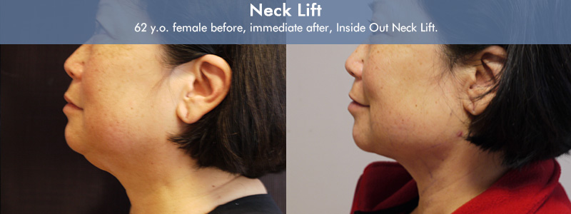 Inside Out Neck Lift Before & After 3