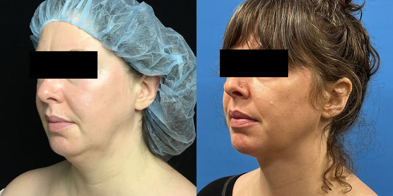 Inside Out Neck Lift Before & After 3