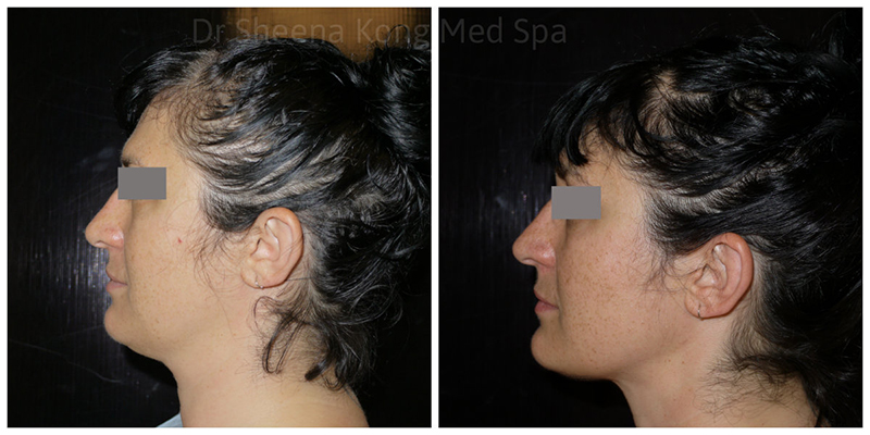 Inside Out Neck Lift Before & After 4