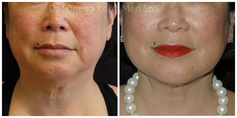 Inside Out Neck Lift Before & After 5