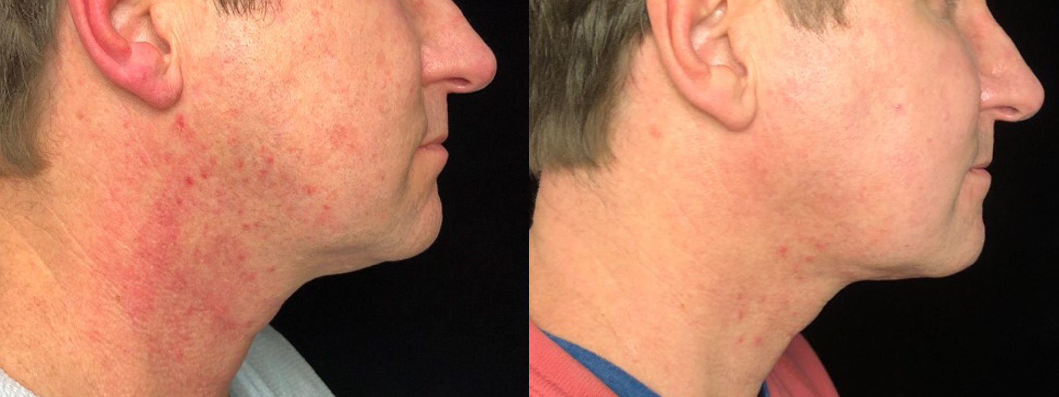 Inside Out Neck Lift Before & After 8