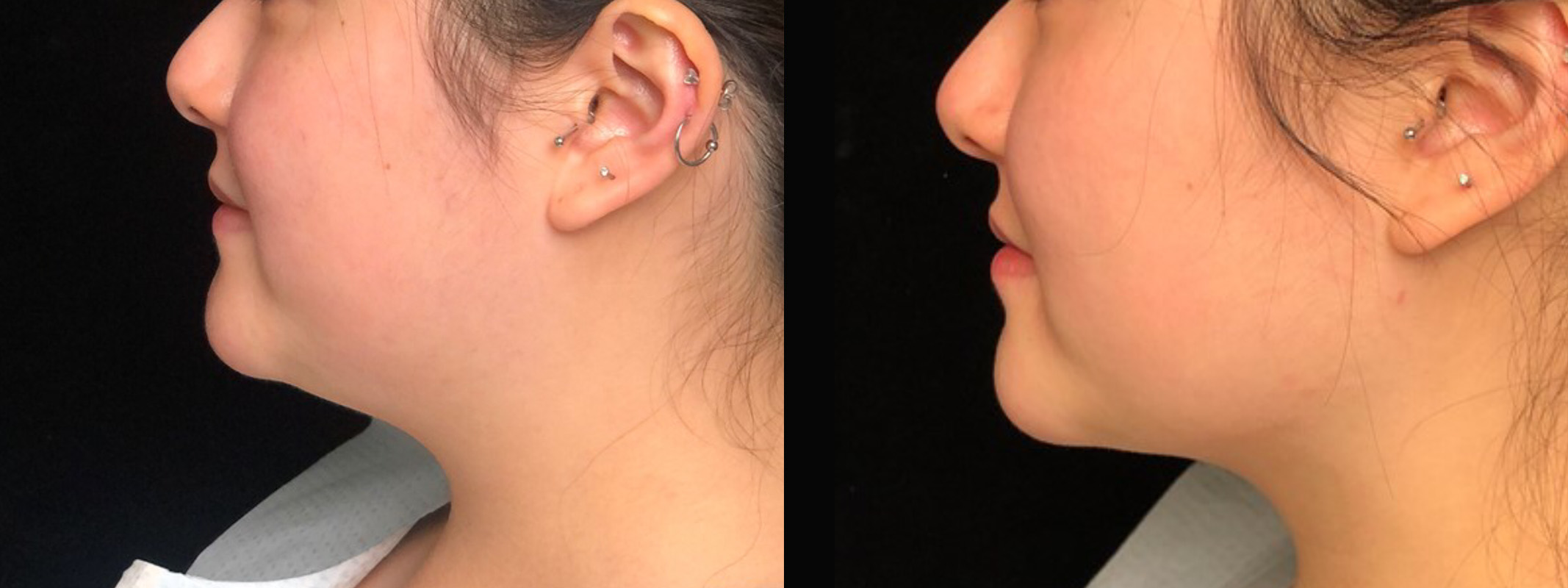 Inside Out Neck Lift Before & After 9