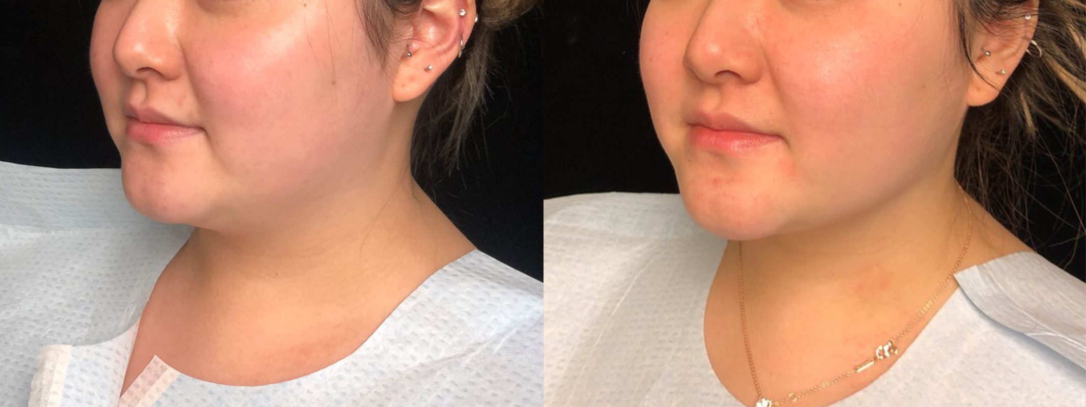 Inside Out Neck Lift Before & After 10