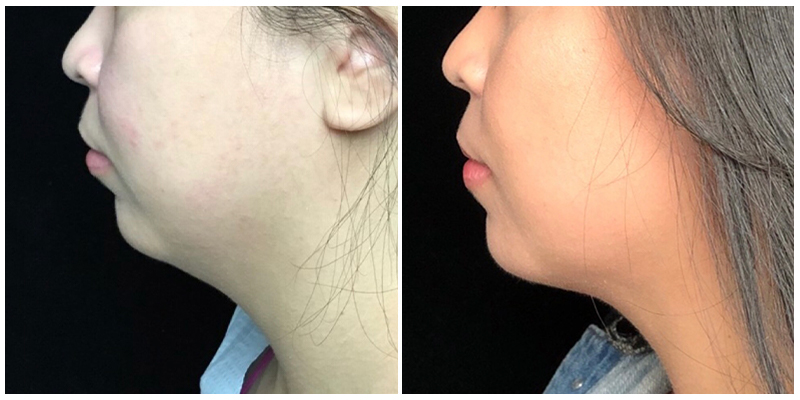Inside Out Neck Lift Before & After 11
